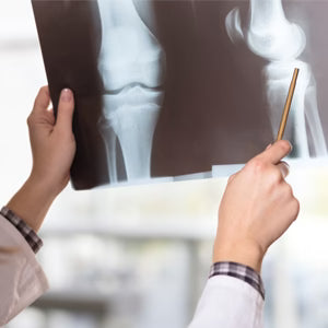 C’est quoi une fracture au genou ?