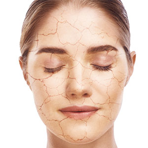 L’hiver et la peau sèche !  Quoi faire ?